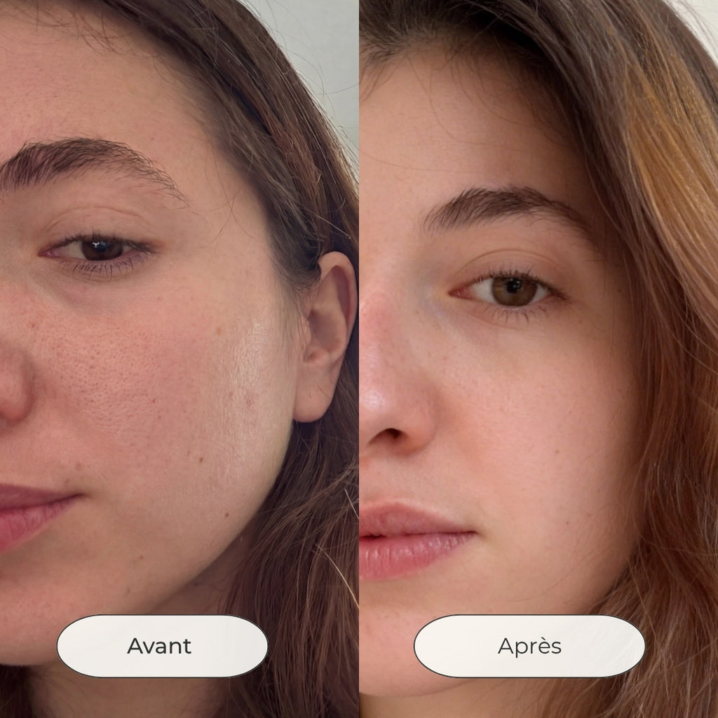Avant après utilisation du masque au lait de chèvre pour réduire les imperfections et boutons