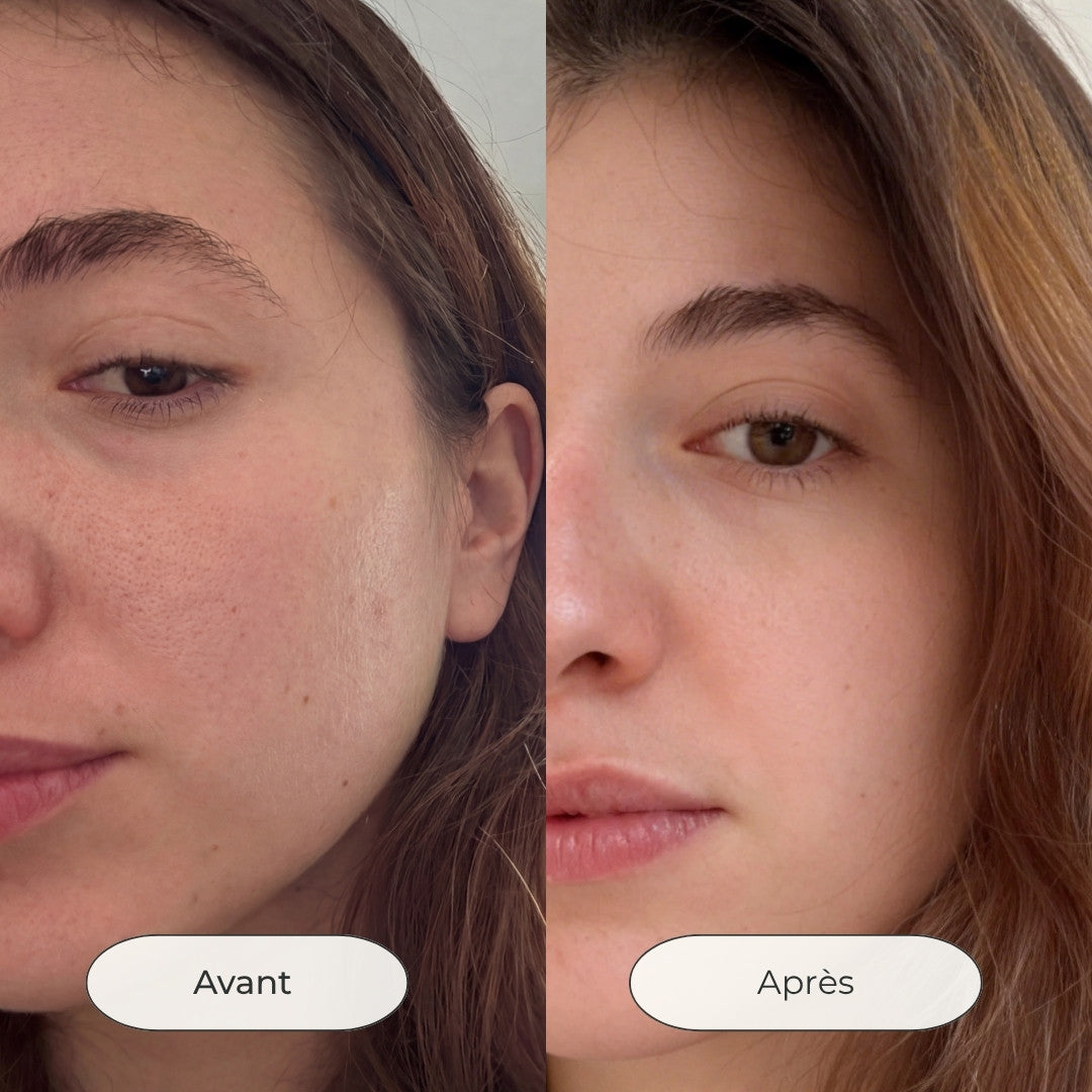 Avant après utilisation du masque au lait de chèvre pour réduire les imperfections et boutons